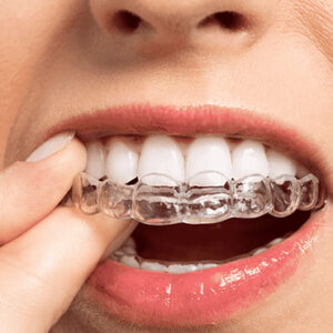 Clear-Aligners