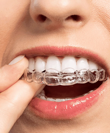 Clear-Aligners