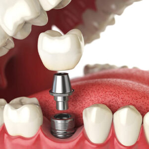 Dental-Implants