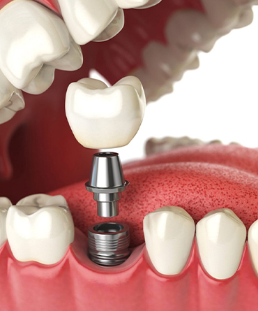 Dental-Implants