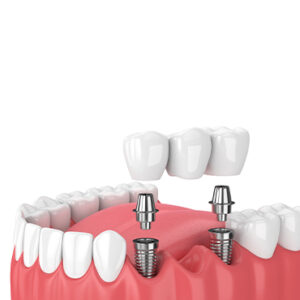 Dental-Implants