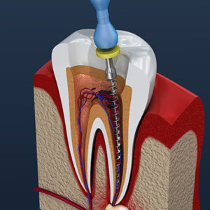 Root-Canal-Treatment