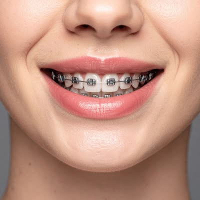 Metal braces on teeth