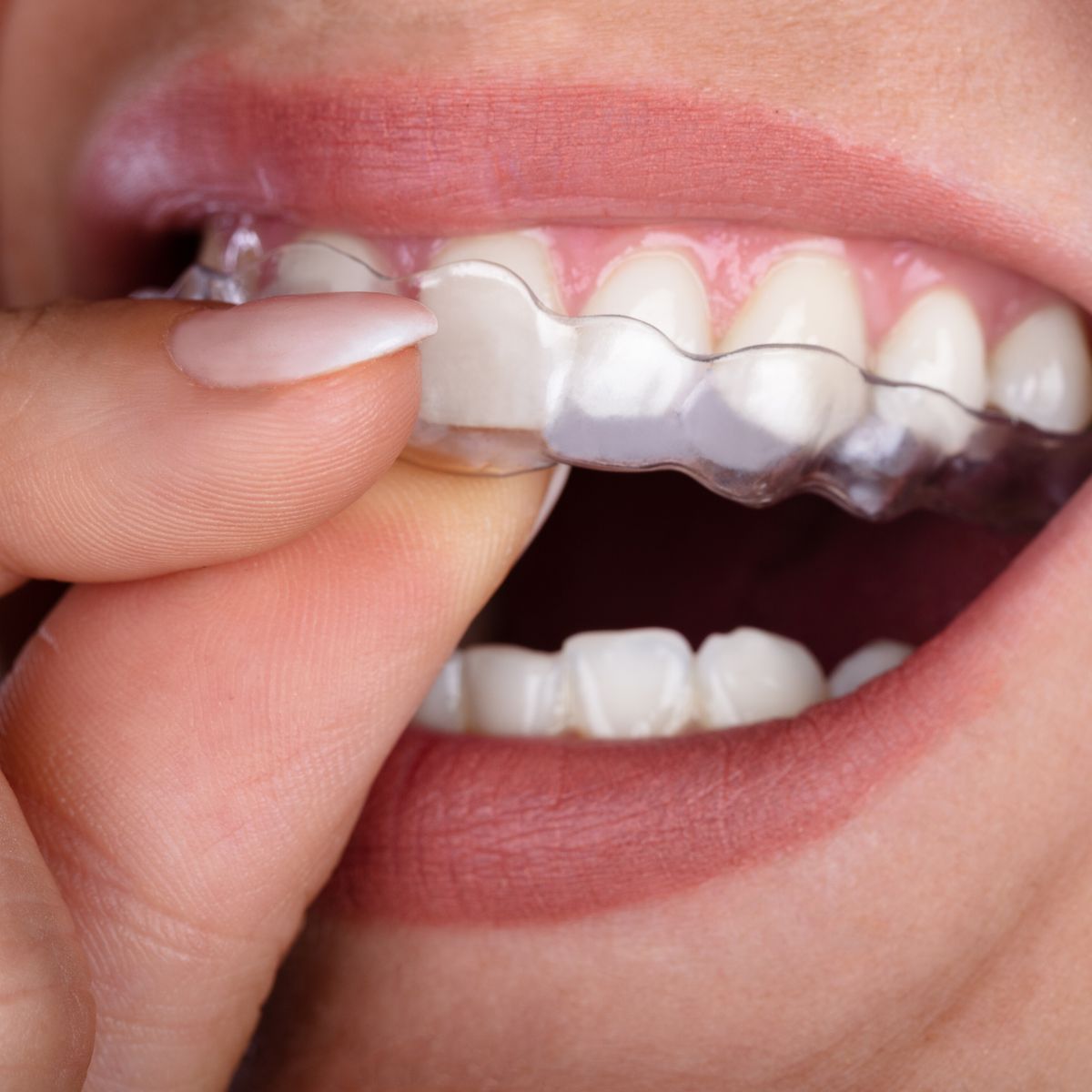 Clear aligner tray on teeth